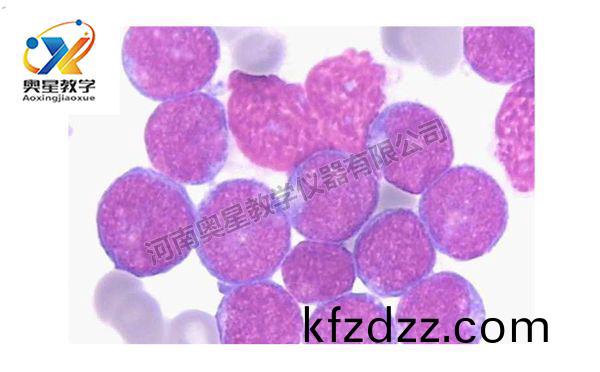 急(ji)性痳(lin)巴(ba)細胞(bao)白血(xue)病(bing)