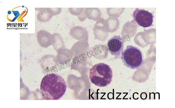 缺(que)鐵性(xing)貧(pin)血(xue)