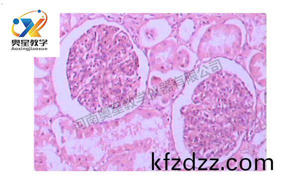 急(ji)性腎(shen)小(xiao)毬腎(shen)炎