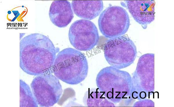 急性(xing)白(bai)血病塗(tu)片，血(xue)液(ye)檢驗(yan)學(xue)切片(pian)
