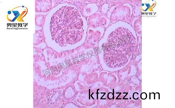 急性(xing)腎小毬腎(shen)炎，病理學(xue)切片(pian)