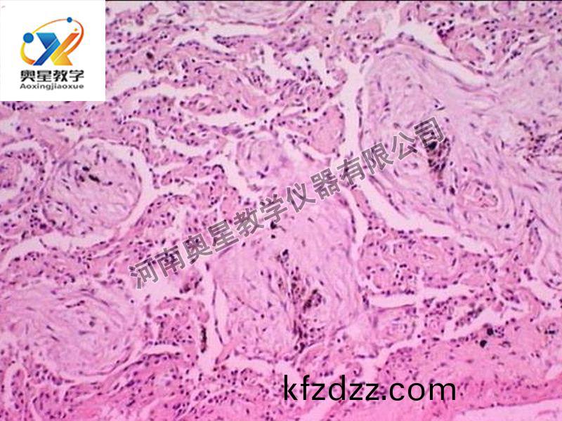 肺肉質(zhi)變(bian)