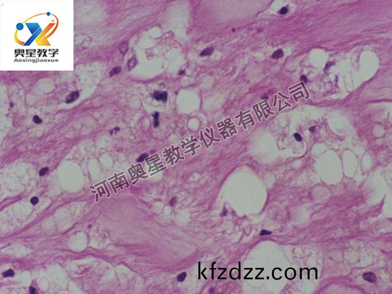 動衇粥樣硬(ying)化(hua)（脂(zhi)紋(wen)）