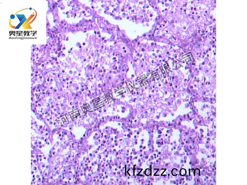 大(da)葉性(xing)肺(fei)炎(灰(hui)肝(gan)期)