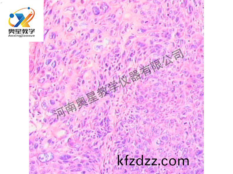 宮(gong)頸鱗癌(ai)