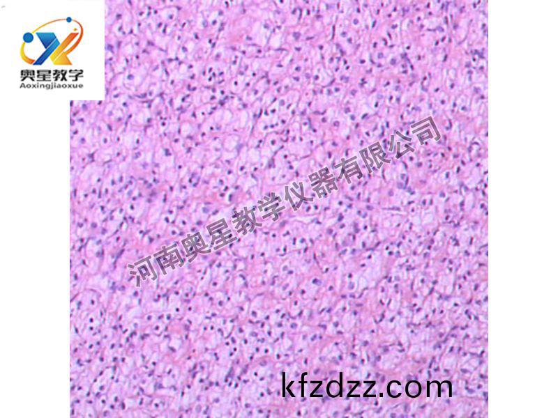 腎透(tou)明細(xi)胞(bao)癌(ai)