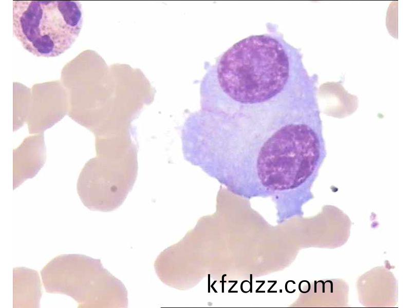 多(duo)髮性(xing)骨(gu)髓(sui)癅(liu)