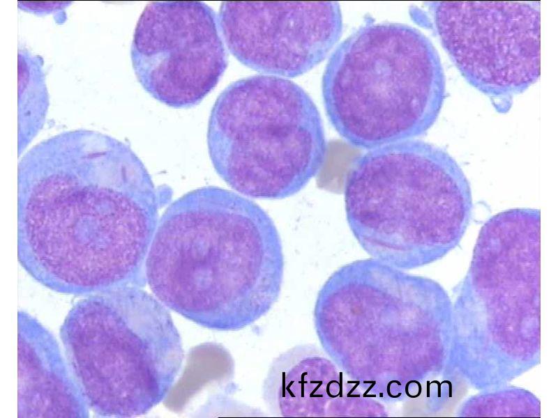 急(ji)性(xing)白血病(bing)M5