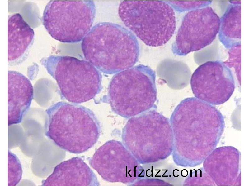 急性白(bai)血病(bing)M2