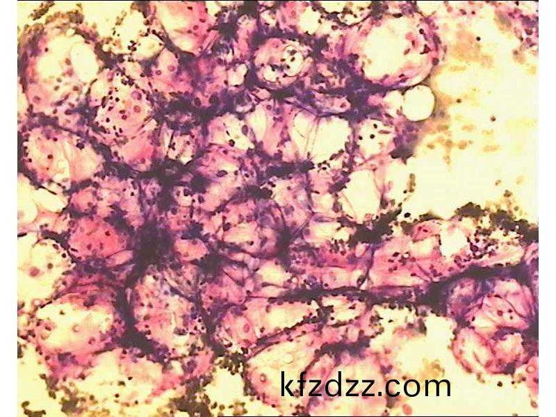 再生(sheng)障(zhang)礙(ai)性貧(pin)血(xue)